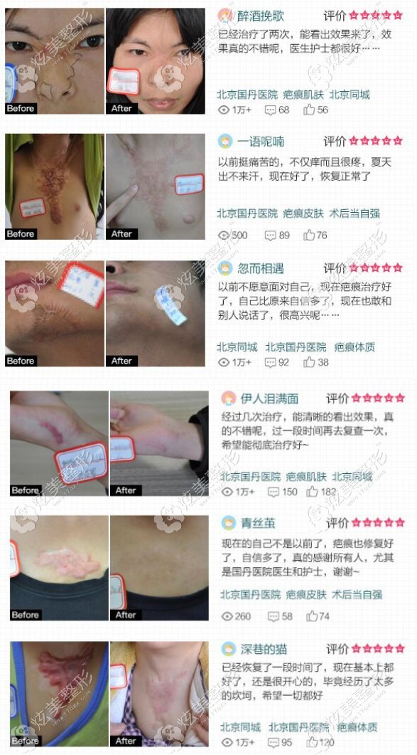 北京国丹医院祛疤好吗?听说口碑不错，想看祛疤效果怎么样