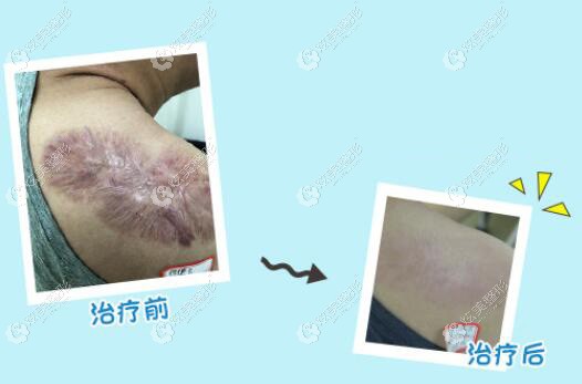 北京国丹挛缩疤痕的治疗 北京国丹挛缩疤痕的治疗