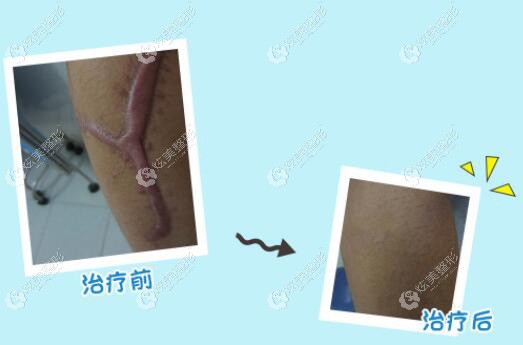 北京国丹手术疤痕的治疗 北京国丹手术疤痕的治疗