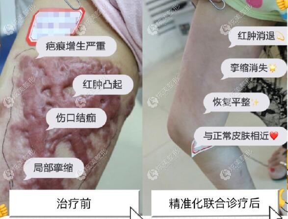 北京国丹疤痕增生的治疗 北京国丹疤痕增生的治疗