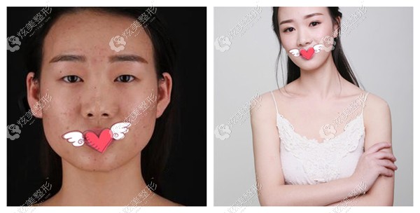 林忠泵医生做无痕翘睫双眼皮的效果 林忠泵医生做无痕翘睫双眼皮的效果