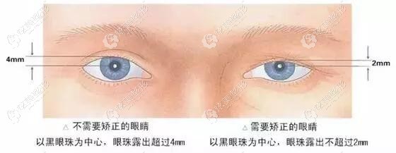 林忠泵医生做无痕翘睫双眼皮手术 林忠泵医生做无痕翘睫双眼皮手术