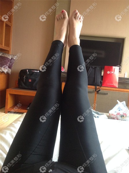 为成都马懿医生做的双侧大腿环形吸脂的效果图点个赞