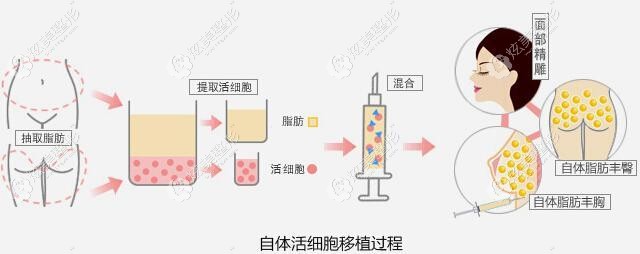 杜医生做脂肪填充原理 杜医生做脂肪填充原理