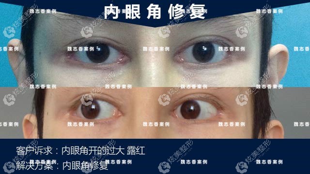 �޸����۽ǿ��Ĺ���¶������