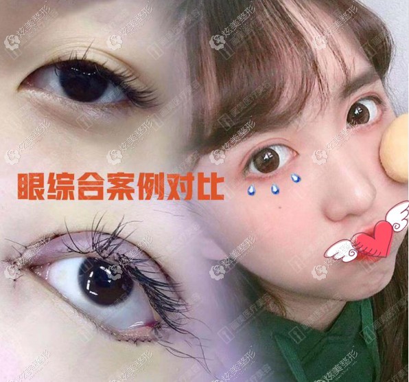 任召磊医生做眼综合对比图