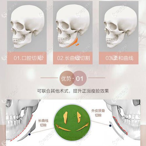 根据口碑评价来看上海美联臣整形做长曲线下颌角手术怎么样