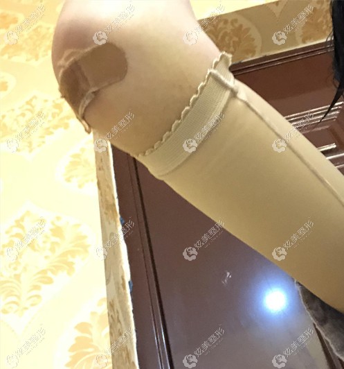 保定驭颜整形做胳膊大腿水动力抽脂的即刻效果图看过没