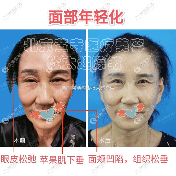 眼皮松弛+苹果机下垂+面颊凹陷+组织松垂做的拉皮手术 眼皮松弛+苹果机下垂+面颊凹陷+组织松垂做的拉皮手术