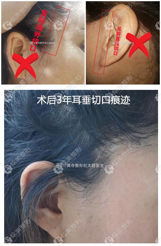 杜太超医生做的拉皮手术恢复没有疤痕 杜太超医生做的拉皮手术恢复没有疤痕
