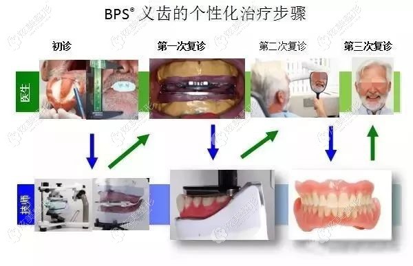 佩戴BPS吸附性义齿的步骤 佩戴BPS吸附性义齿的步骤