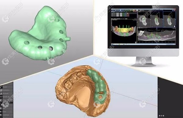 李长江做种植牙用3D导板辅助 李长江做种植牙用3D导板辅助