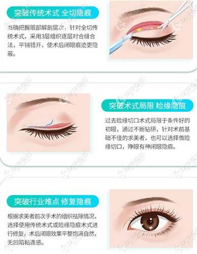 郑颖平在爱思特做双眼皮的优势 郑颖平在爱思特做双眼皮的优势