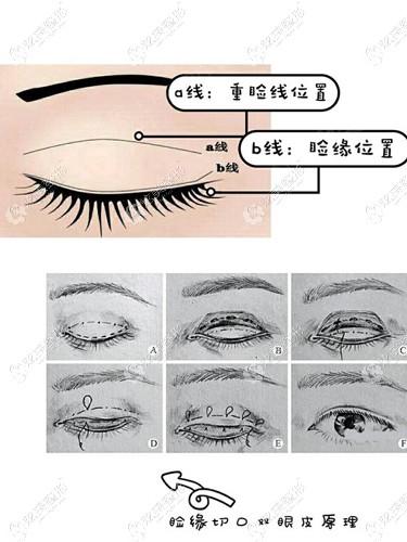 采用睑缘切口做双眼皮的原理 采用睑缘切口做双眼皮的原理