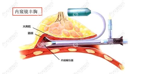 西安米兰柏羽整形做内窥镜隆胸的技术 西安米兰柏羽整形做内窥镜隆胸的技术