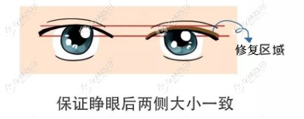 郭广科医生做的大小眼修复过程 郭广科医生做的大小眼修复过程