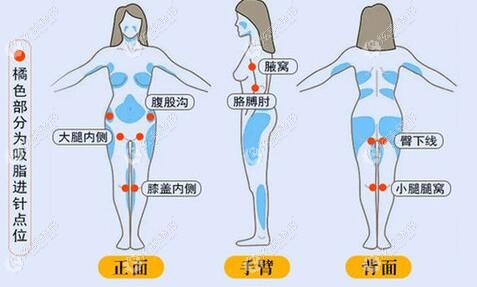 陈磊医生做抽脂手术进针隐蔽 陈磊医生做抽脂手术进针隐蔽