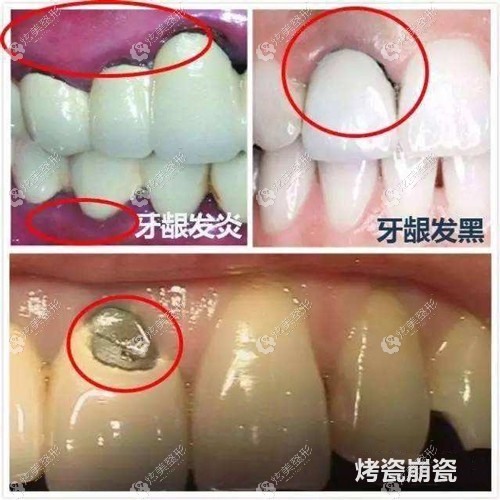 烤瓷牙牙龈发黑会造成的危害