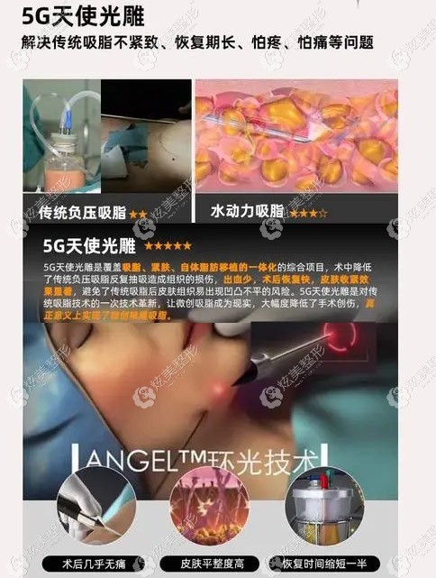 桑建波医生做面部吸脂主要用的是5G天使光雕 桑建波医生做面部吸脂主要用的是5G天使光雕
