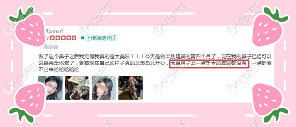 昆明吴氏嘉美整形吴承道医生做隆鼻实例 昆明吴氏嘉美整形吴承道医生做隆鼻实例