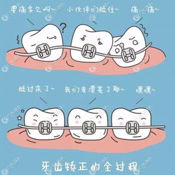 上海圣贝做牙齿矫正的原理