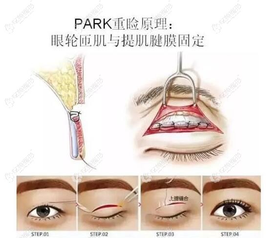 王志是五洲莱美整形主推做Park法眼综合的医生 王志是五洲莱美整形主推做Park法眼综合的医生