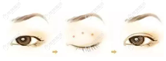 严飞做的眼综合对比照 严飞做的眼综合对比照