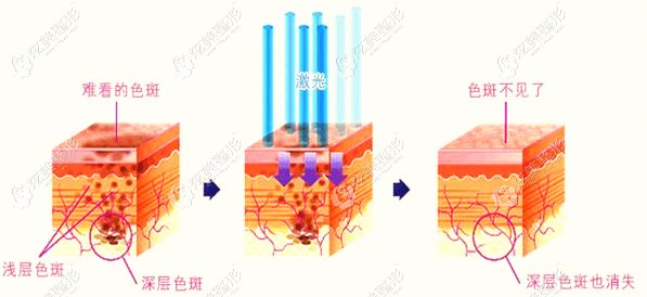 张羽晶医生做激光祛斑 张羽晶医生做激光祛斑