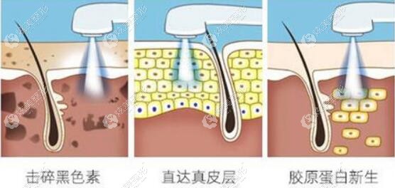 吴凡医生做激光祛斑过程 吴凡医生做激光祛斑过程
