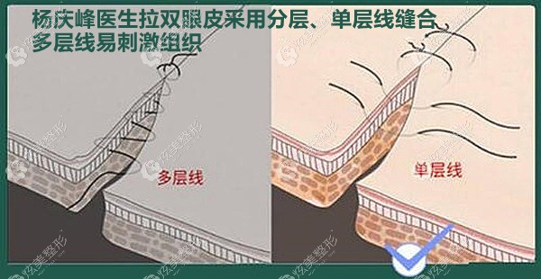 杨庆峰医生拉双眼皮缝合的优势点 杨庆峰医生拉双眼皮缝合的优势点