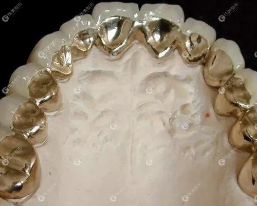 纯钛金属牙齿的模型