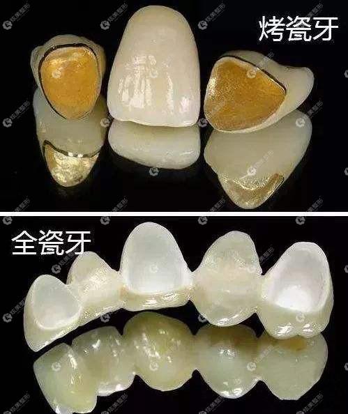 纯钛烤瓷牙和全瓷牙的模型区别