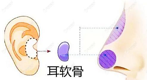 耳软骨垫鼻尖 耳软骨垫鼻尖