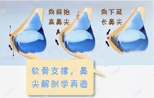耳软骨垫鼻尖的优点 耳软骨垫鼻尖的优点