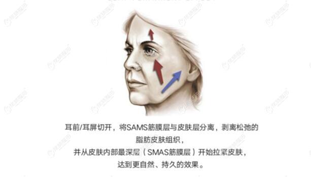 宋华敬医生沿耳前耳后切口组织并剥离 宋华敬医生沿耳前耳后切口组织并剥离
