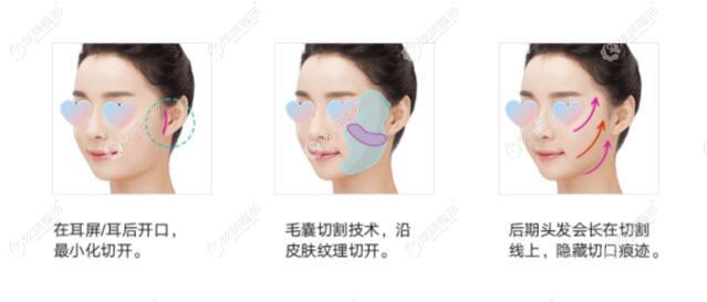 宋华敬医生做拉皮手术的疤痕几乎看不到 宋华敬医生做拉皮手术的疤痕几乎看不到