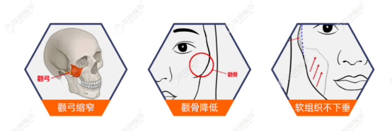 张立天做的面部轮廓手术过程 张立天做的面部轮廓手术过程
