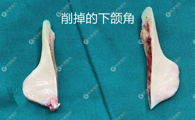 下颌角磨骨和削骨手术哪个好呢据了解两个手术一起做会更自然