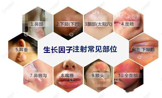 注射生长因子部位不同,价格不一样