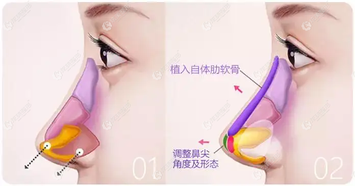 台州博仕整形做鼻子对比图 台州博仕整形做鼻子对比图