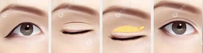 刘昕做显微双眼皮手术过程 刘昕做显微双眼皮手术过程