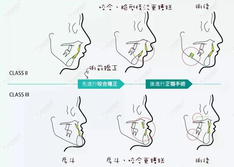 正颌手术的过程图解