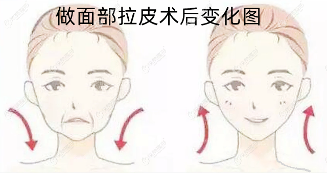 面部拉皮术后对比图 面部拉皮术后对比图