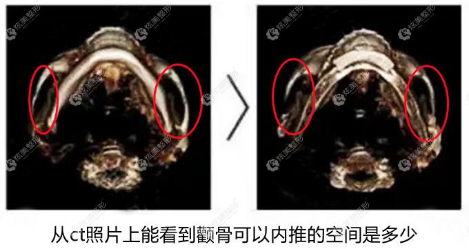 颧骨内推ct图片