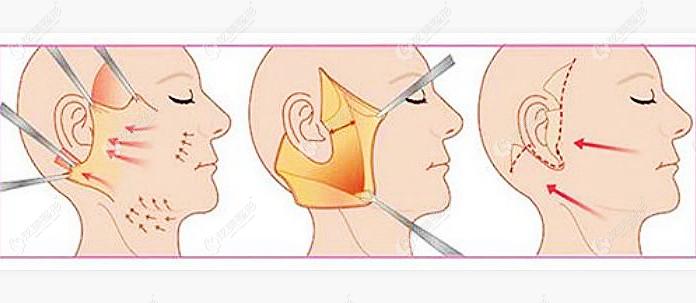 全国耳再造名医有哪些了解这份国内小耳再造医生排名榜就能知道