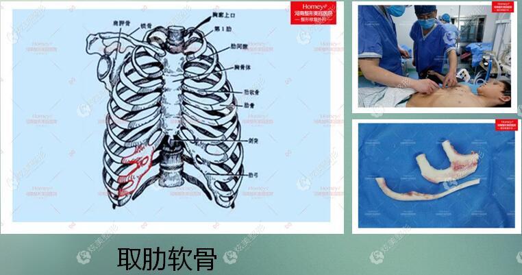 张正文医生取自体肋软骨做耳再造手术费用低 张正文医生取自体肋软骨做耳再造手术费用低