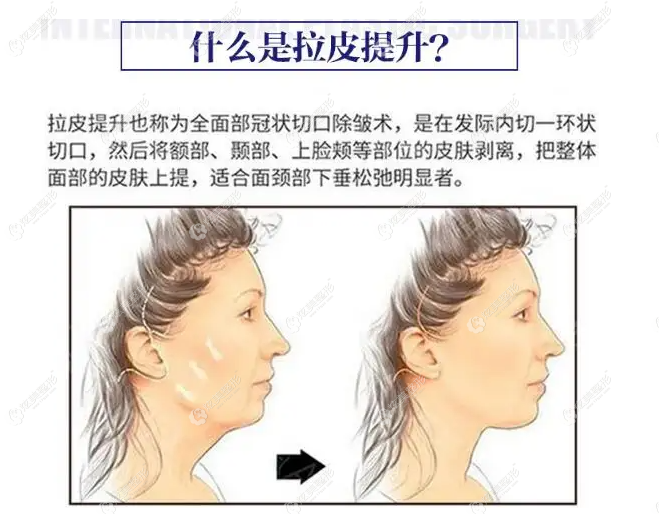 大拉皮手术的切口一般都是从耳前延伸到耳后 大拉皮手术的切口一般都是从耳前延伸到耳后