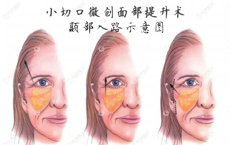 小拉皮提升的切口通常是2-4cm处于发际线内 小拉皮提升的切口通常是2-4cm处于发际线内