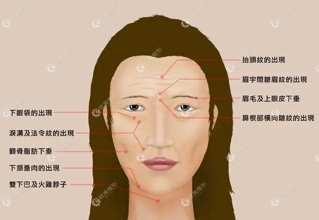 大拉皮适合40岁以上且面部松弛程度为中重度的人群 大拉皮适合40岁以上且面部松弛程度为中重度的人群