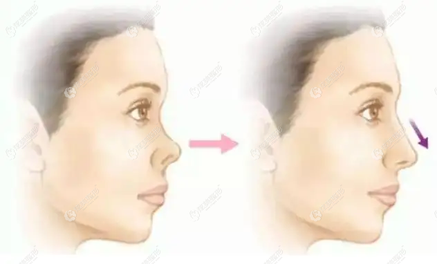 鼻小柱延长术前后对比